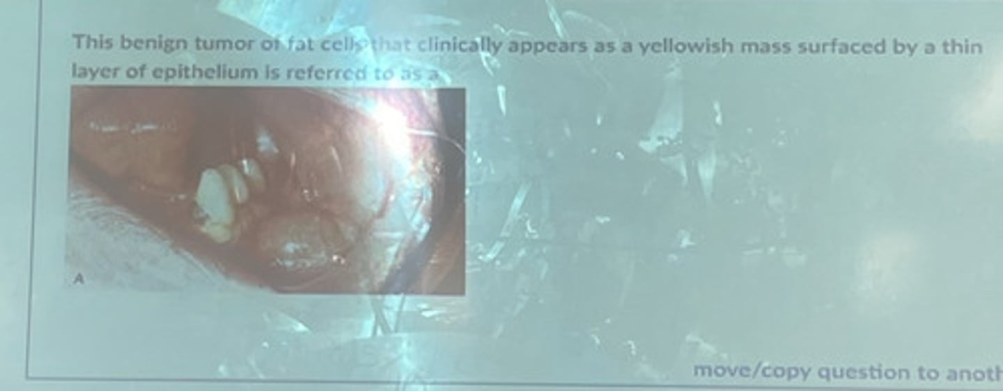 <p>This benign tumor of fat cells that clinically appears as a yellowish mass surfaced by a thin layer of epithelium is referred to as</p>