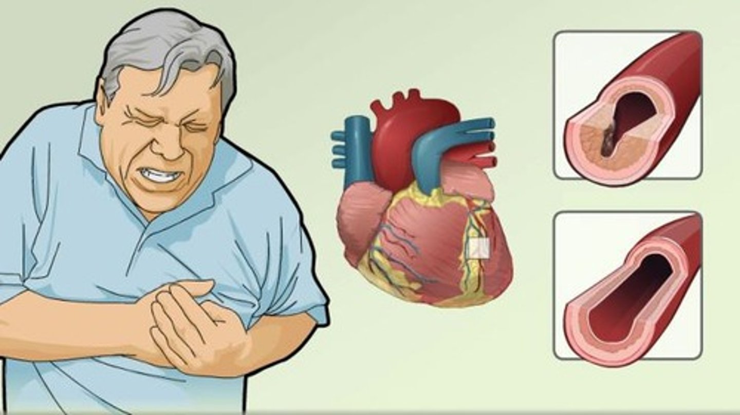 <p>RV infarction is most associated with inferior wall myocardial infarction and occurs due to occlusion of the proximal right coronary artery.</p>