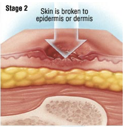 <ul><li><p>Damage to the epidermis ± dermis</p></li><li><p>Edema, blistering, minor bleeding/fluid drainage, pain</p></li></ul>