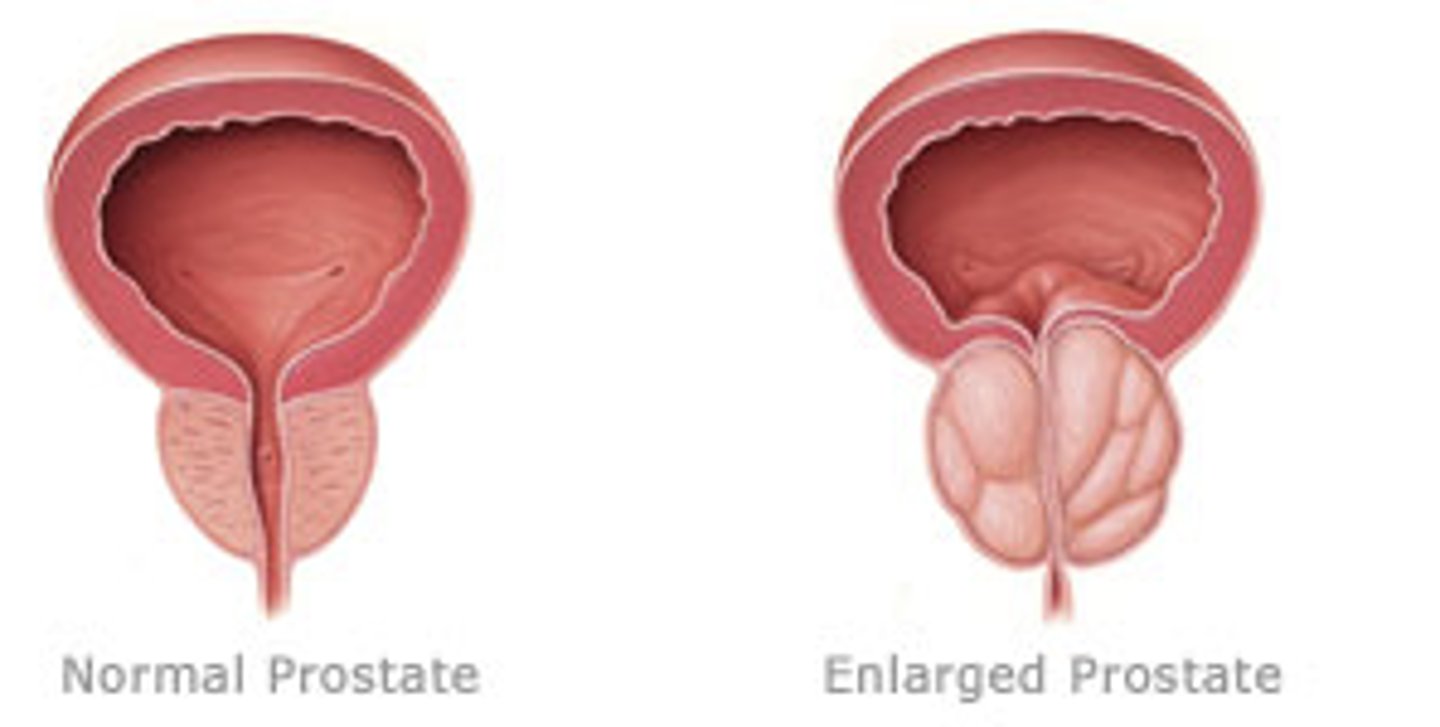 <p>Prostate hyperplasia.</p>