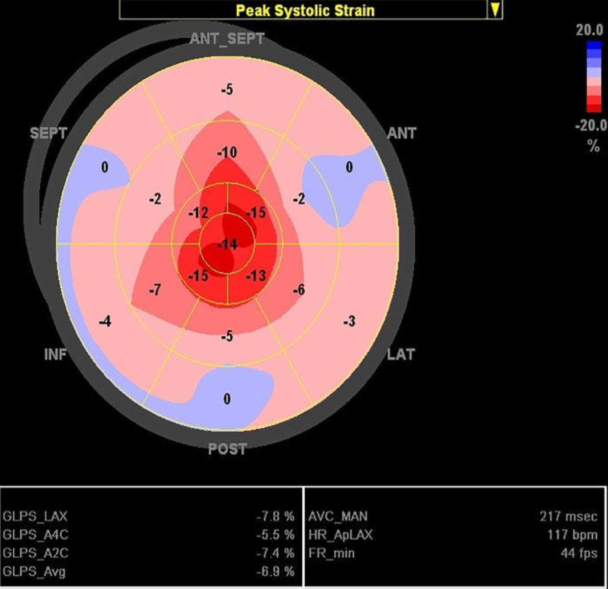 <ul><li><p>Apical Sparing: a preservation of contractility in the apical segments, with a decrease in the basal &amp; mid segments</p></li><li><p>It is NOT specific for amyloidosis</p></li></ul>