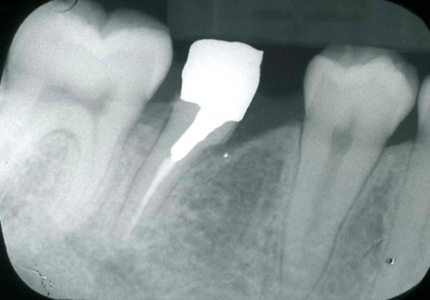 <p>ID the surgical procedure:</p><p>- <u>Defective root + overlying coronal tooth structure is removed</u></p><p>- Bicuspidization - <strong>Mand molar is separated into mesial + distal </strong>halves due to furcational defect.</p>