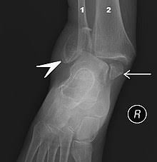 <p>What fracture is this? </p>