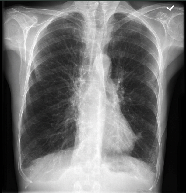 <p>What pathology is seen on this x-ray?</p>