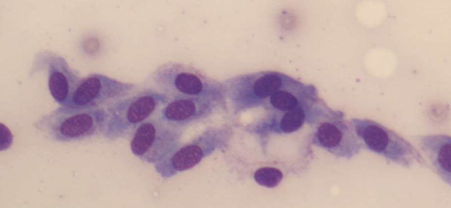 <p>lining cells from the arachnoid</p>