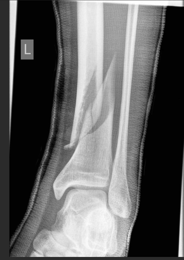 <p>What is a spiral bone fracture?</p>