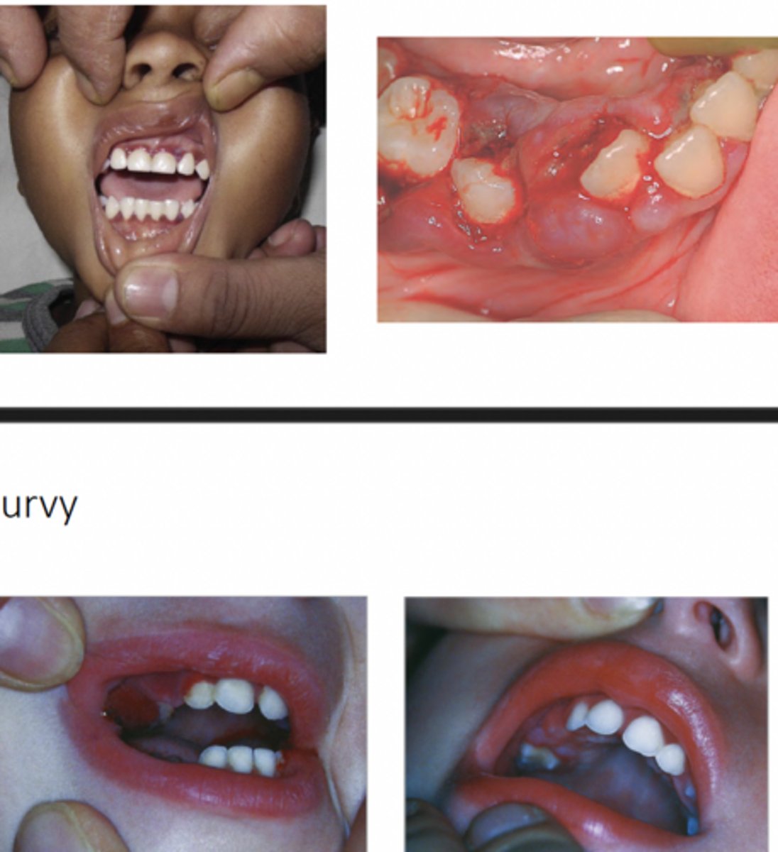 <p>scorbutic gingivitis:</p><p>-generalized gingival swelling w/ spontaneous hemorrhage</p><p>-ulceration</p><p>-tooth mobility</p><p>-periodontal disease</p>