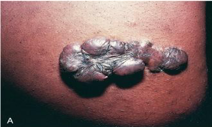 An 18-year-old man lacerated his left upper arm and required sutures. The sutures were removed one week later. Wound healing continued, but the site became disfigured over the next two months by the process shown in the figure. Which of the following terms best describes the process that occurred in this man?