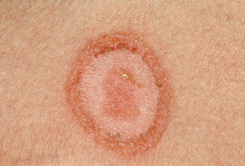 Imperfect fungi
'ringworm'