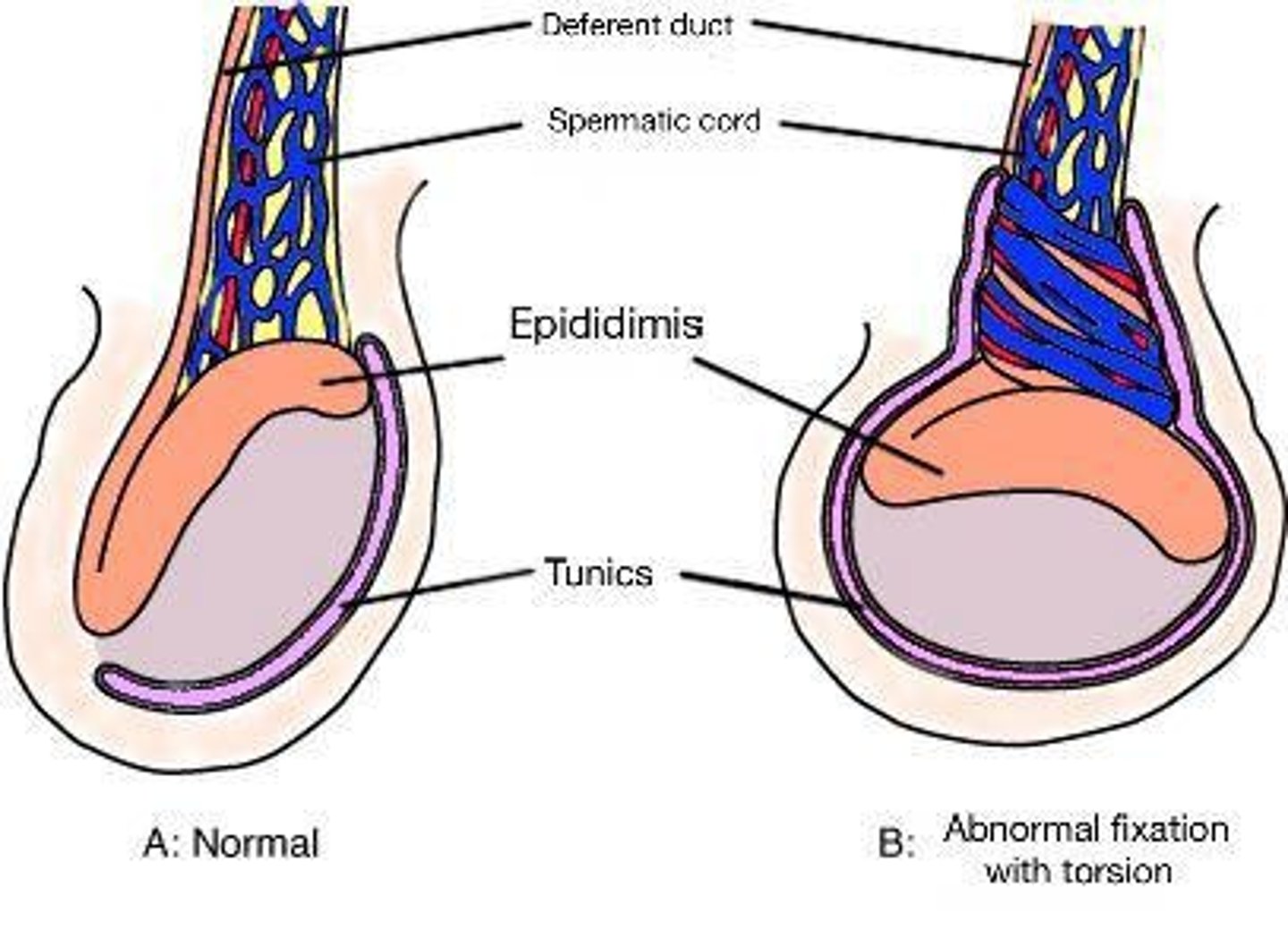 <p>Rotation of the testicle leading to venous obstruction, arterial ischemia, and potential infarction.</p>