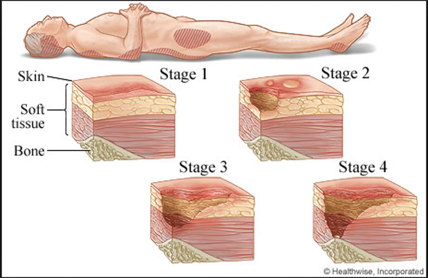 <p>Stage 1: vigorous pressure, friction and moisture-alleviating measures required (positioning and off loading)</p><p>Stage 2: dermis is exposed - if no infection, appropriate dressing that occludes wounds from environment, pressure alleivating and mositure-alleviating techniques</p><p>Stage 3: Requires debridement, dressings and advanced pressure alleviating measures</p><p>Stage 4: debridement, dressings, pressure alleviating, surgery and grafting</p>