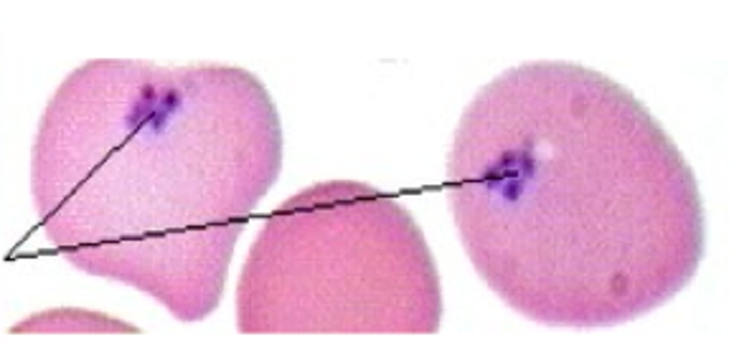 <p>-iron inclusion <br>-splenectomy, hemolytic anemia</p>