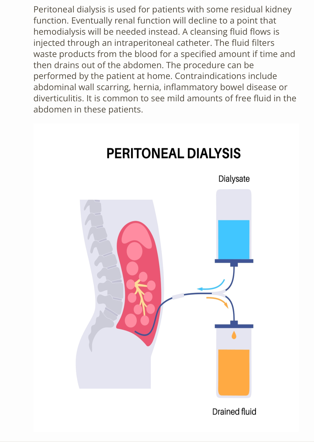 <p>A) A cleansing fluid flows, and injected through intro peritoneal catheter</p>
