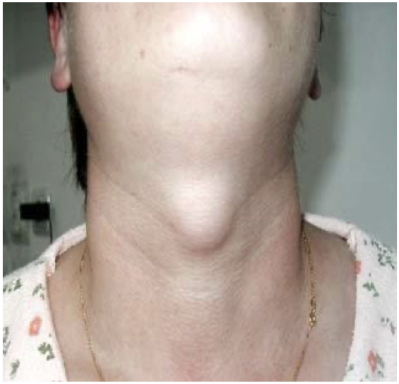 <p>A 45 year old presented with a cystic swelling in midline of the neck. Provide DD</p>