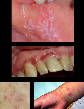 <p><span style="color: blue;"><strong><em><u>AUTOIMMUNE</u></em></strong></span></p><p>Lichen Planus</p><ul><li><p>Clinical Signs</p></li><li><p>Etiology</p></li><li><p>Treatment</p></li></ul><p></p>