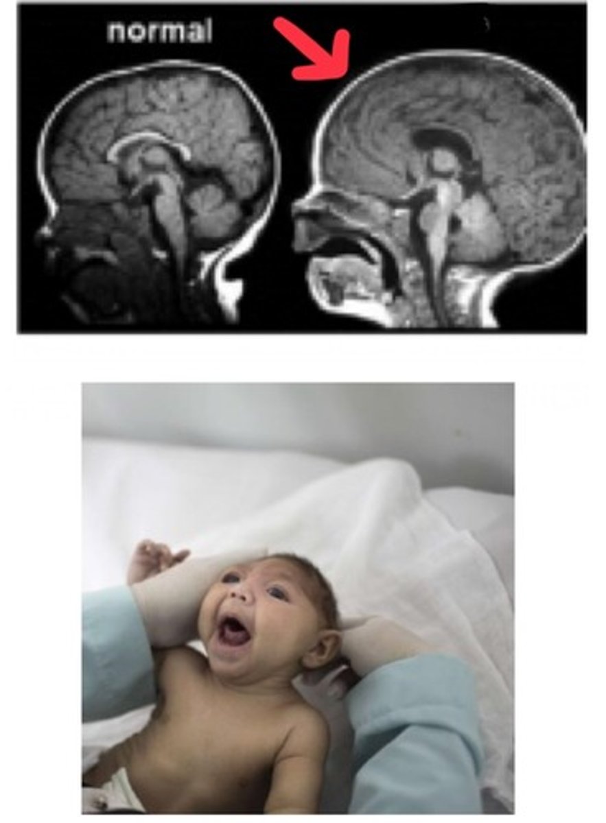 <p>Define Megalencephaly</p>