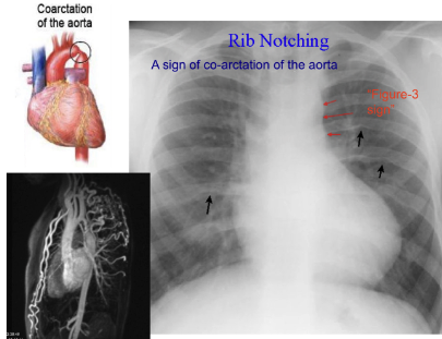 <p>sign of coractation of aorta</p><p>collateral circulation involving internal thoracic and intercostal arteries (may result in enlargement of intercostals)</p>