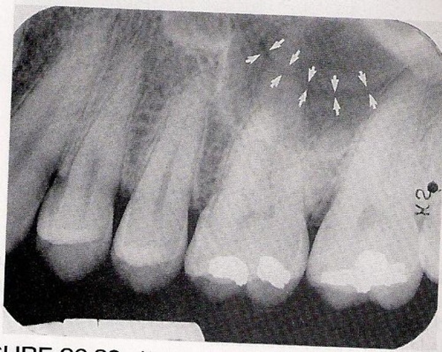 <p>Radiolucent lines in bone; contains blood vessels and exhibit radiopaque borders</p>
