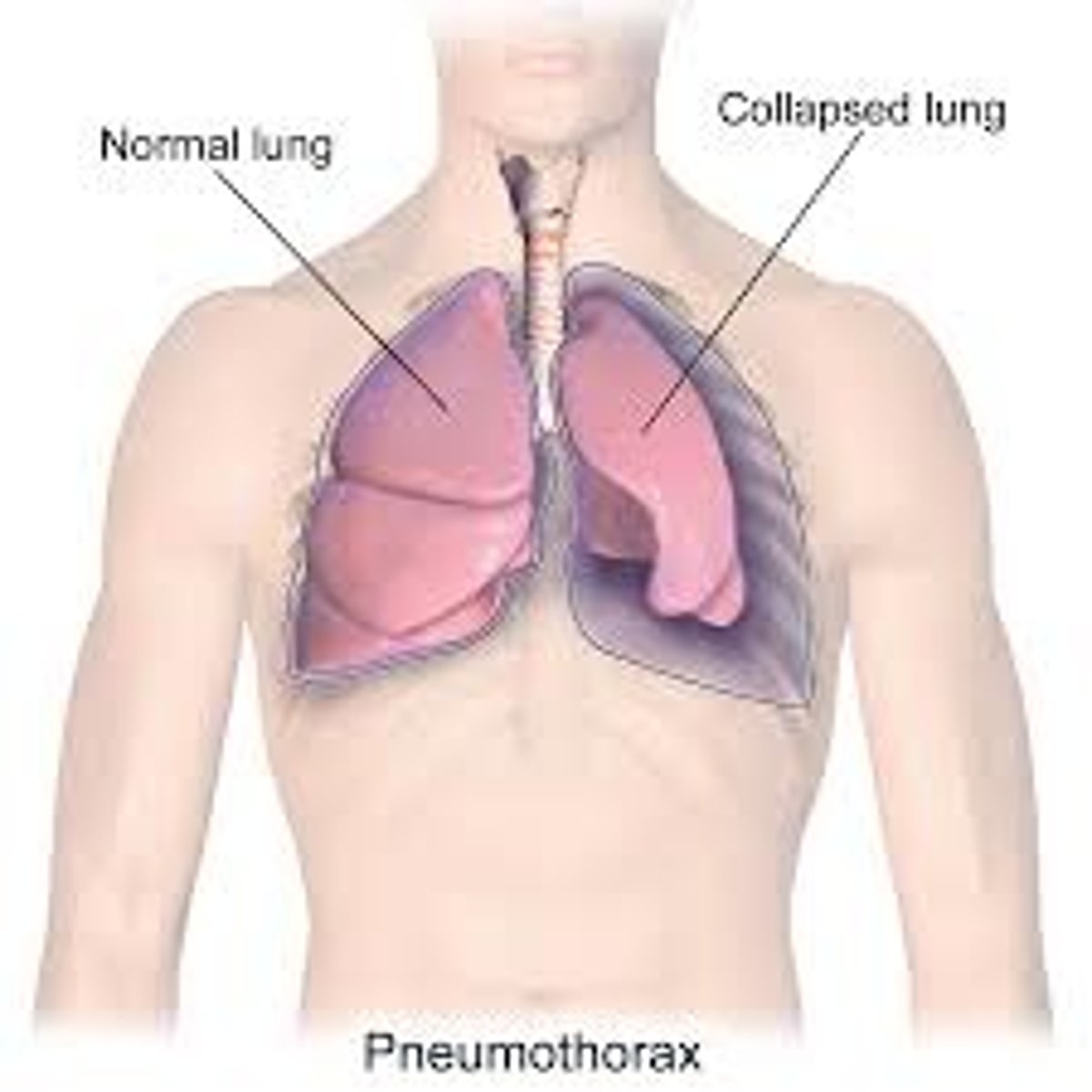 <p>- accumulation of air in the pleural space known as a collapsed lung</p><p>- caused by trauma or is spontaneous</p>