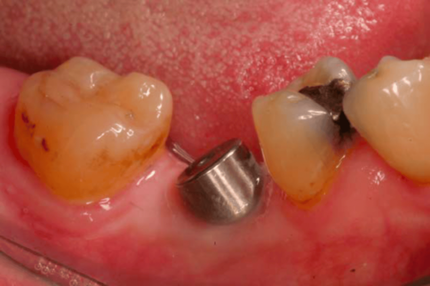 <p>Which impression technique should be used here?</p>