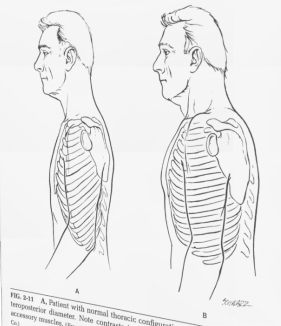 <p>Barrel chest</p>