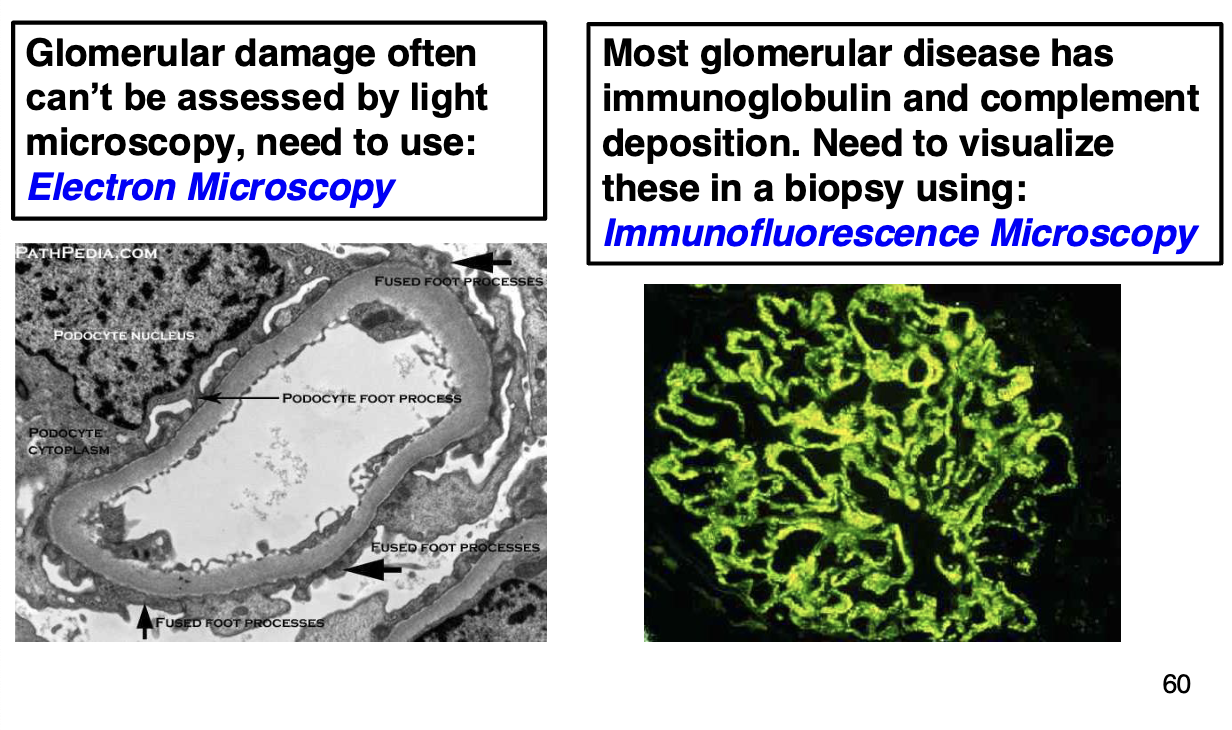 <ul><li><p>must use special lab techniques for precise diagnosis of the type of glomerulonephritis, which will determine treatment</p></li></ul><p></p>
