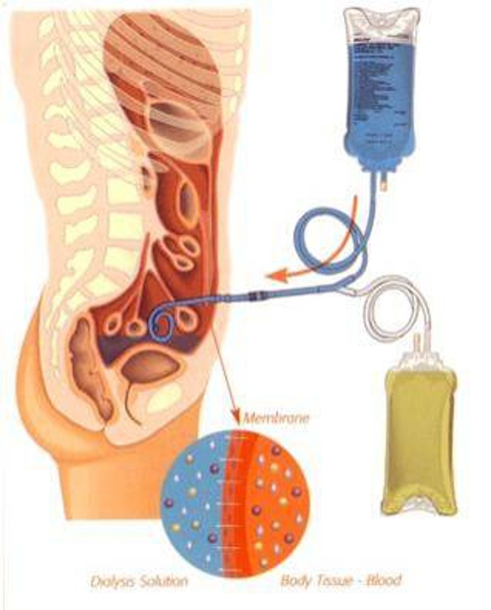 <ul><li><p>The abdomen has a lining called the peritoneum</p></li><li><p>Dialysis fluid is inserted into the abdomen through a catheter</p></li><li><p>It is left there for several hours, and urea and excess mineral ions pass out of the blood capillaries into the tissue fluid, and then out across the peritoneal membrane into the dialysis fluid</p></li><li><p>The fluid is then extracted from the abdomen</p></li><li><p>The water potential and ion concentration in the blood has been restored</p></li></ul><p></p>