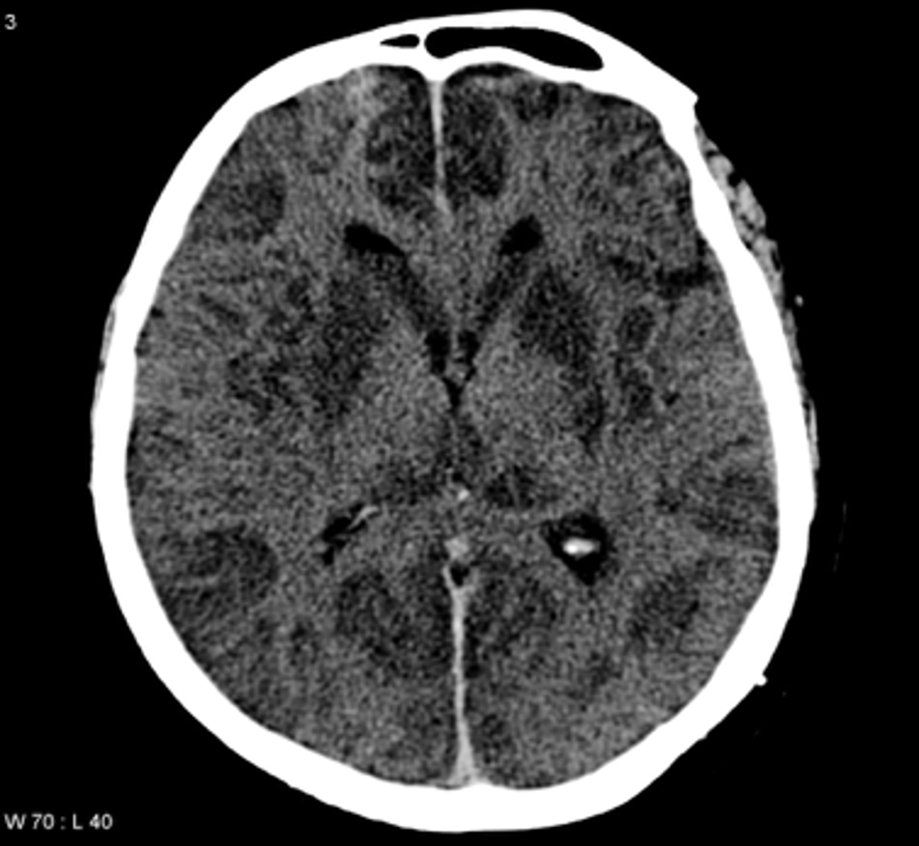 <p>Cardiac arrest<br>Shock<br>CO poisoning<br>High altitudes<br>Choking<br>Stroke</p>