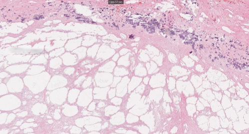 <p>necrosis of adipose tissues, between lytic and coagulative. </p>