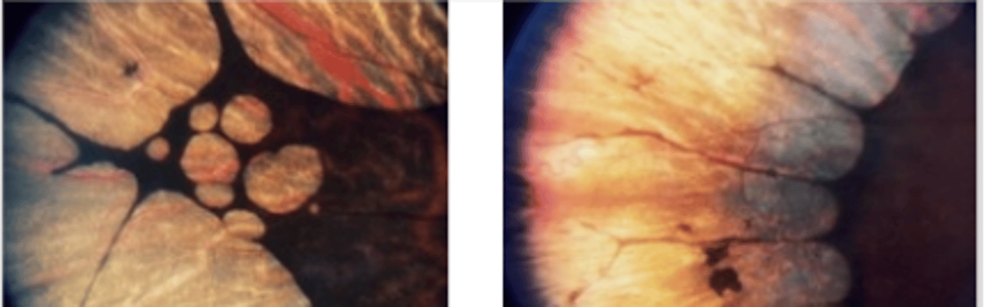 <p>an autosomal recessive condition resulting in a metabolic defect due to mutation of the ornithine degradation enzyme. Leads to a buildup of ornithine in plasma, urine, CSF, and aqueous. Presents as a reduction in peripheral and night vision. Patches of choroiretinal atrophy coalesces to form scalloped lesions. Spares the fovea until late disease (4th-5th decade), prognosis is poor. Treatment includes pyridozine (vitamin B6) and limitation of arginine intake (low protein).</p>