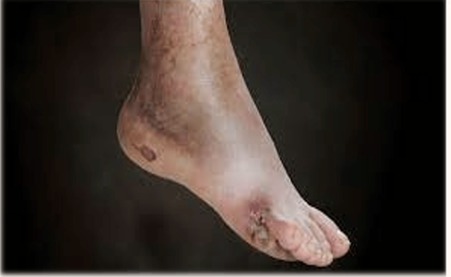 <p><span><strong>COMMON complication of long-term diabetes mellitus</strong>. Metabolic and vascular changes cause damage to peripheral and autonomic nerves (feet, retina). Sensory loss can lead to foot injuries that progresses to infection and gangrene (see example below)</span></p><p style="text-align: left;"><span>-Numbness, prickling, tingling, stabbing sensation that is worse at night. Allodynia is common.<br><em>Example: In a patient with severe diabetic neuropathy, if they step on thumbtack, are exposed to extreme temperatures,&nbsp; if a small rock/object becomes lodged in their shoe, or if dry skin becomes cracked and exposed, they may not feel it at all. These injuries can lead to breakdown and ulcerations (these patients also do not have good wound healing, which puts the patient at further risk for tissue damage). The nurse should teach the patient to do regular foot care and foot checks, podiatry is often part of the care team for patient’s with diabetic neuropathy. *</em></span></p>