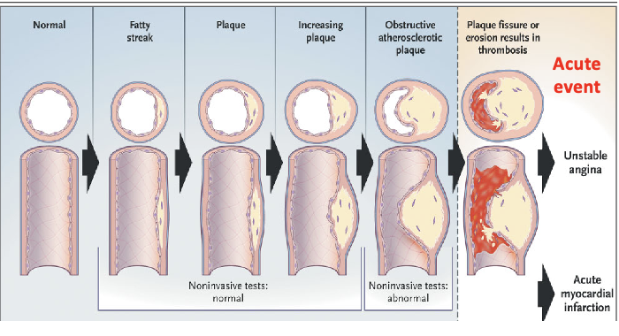 <ul><li><p><span>Damage to artery wall (caused by smoking, diabetes, hypertension etc) →  inflammation and build up of fatty plaques (atheroma) in walls of coronary arteries</span></p></li><li><p><span>If the plaque ruptures → platelet activation, aggregation and thrombus formation</span></p></li><li><p><span>thrombus can break loose and travel to other part of body (embolus)</span></p></li></ul><p></p>