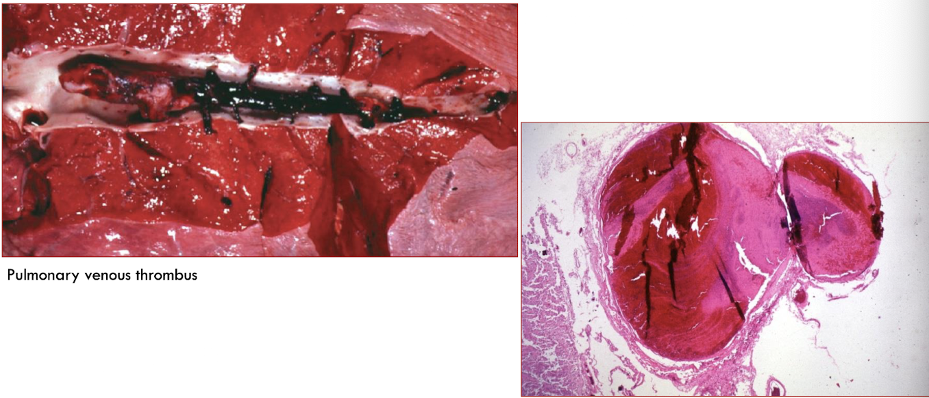<p>gelatinous, <strong>soft</strong>, glistening</p><p><strong>dark</strong> <strong>red</strong></p><p>almost always <strong>occlusive</strong> → molded to wall</p><p>often extend <strong>upstream</strong> from point of origin</p>