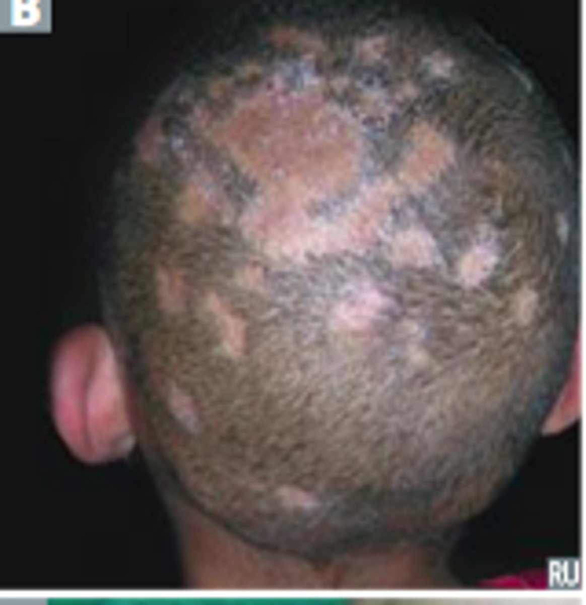 <p>Ans: (B)</p><p>Scaling, crusting, and hair loss are seen in the scalp of individuals with tinea capitis. Usually, a painful plaque called kerion and an enlarged occipital lymph node accompany this baldness.</p>