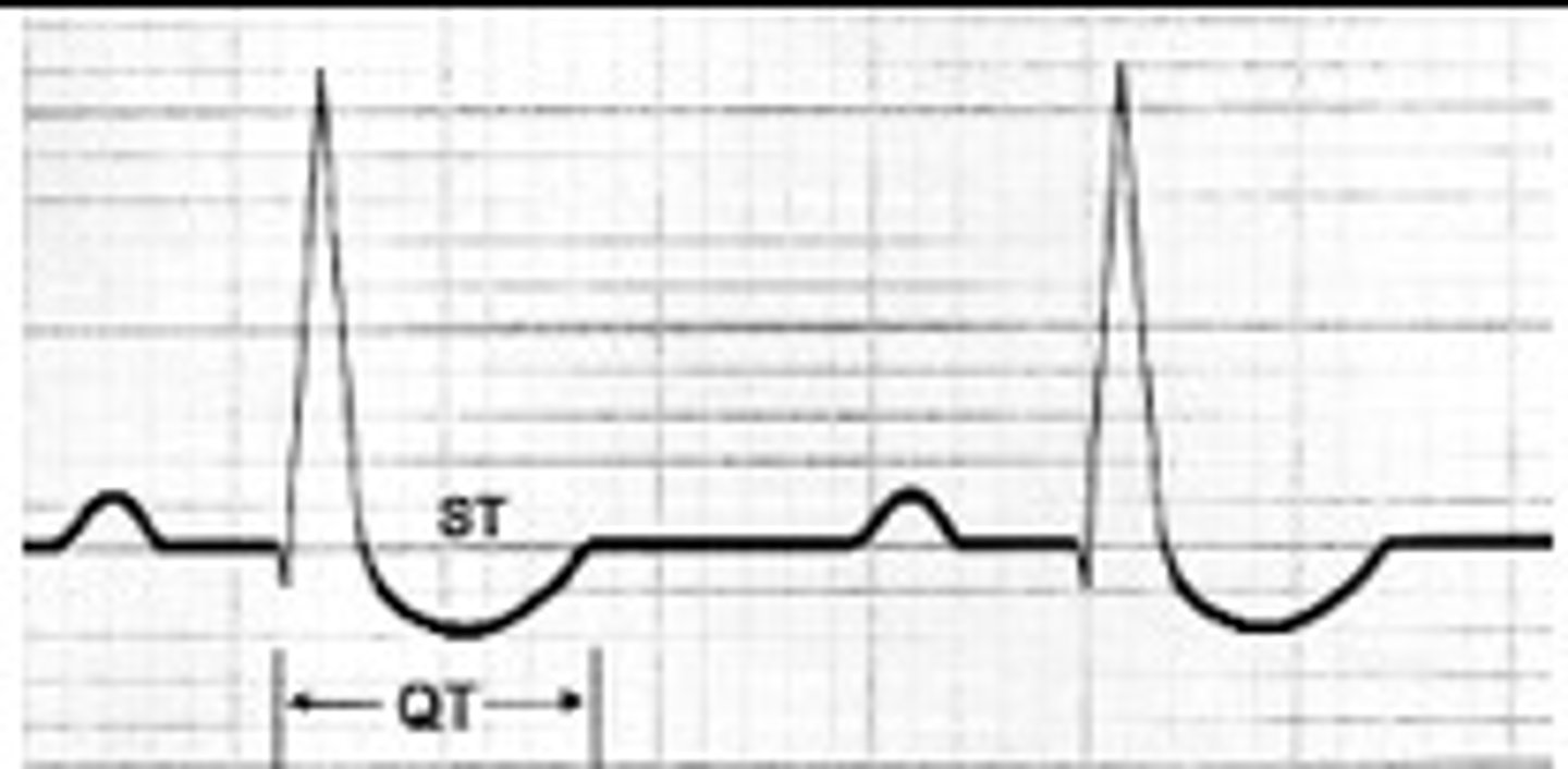 <p>- shortened QT interval</p><p>- characteristic down-sloping ST depression (SCOOPING ST seg)</p>