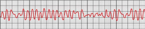 <p>What arrhythmia is this?</p>