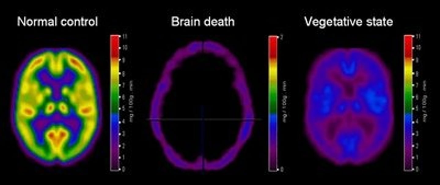 <p>No brain activity or response to stimulus. Absence of cerebral blood flow and organ function - Not Awake or Aware</p>