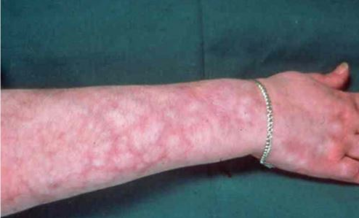 <p><span>a skin condition characterized by a bluish-red, lace-like or web-like pattern on the skin, typically on the arms, legs, or trunk</span></p>