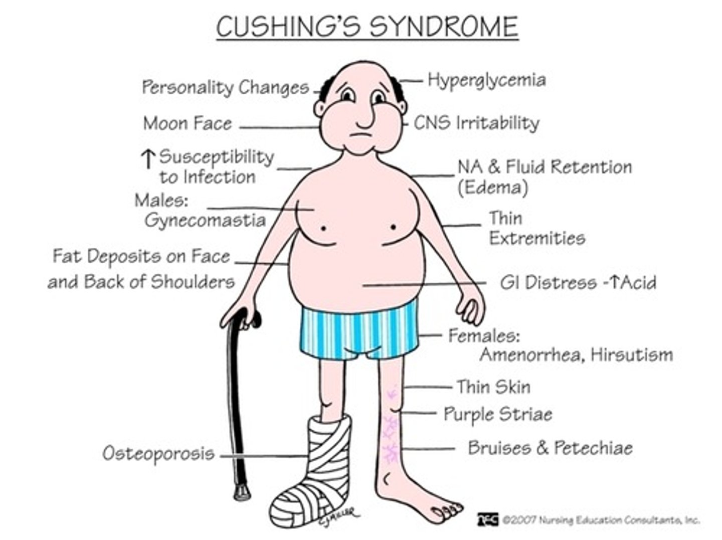<p>All side effects of steroid medications</p><p>DRAW THE MOON MAN!!</p><p>- Moon face</p><p>- Has a beard (Hirsutism)</p><p>- Truncal or central obesity</p><p>- Weak arms/legs (Muscle atrophy)</p><p>- Gynecomastia</p><p>- Buffalo hump</p><p>- Retaining Na+ and H2O</p><p>- Losing K+ out the back</p><p>- Stretch marks</p><p>- HIGH SERUM GLUCOSE!! Do accu-checks q6h.</p><p>- "I'm mad I have an infection" Roid rage</p><p>- Immunosuppressed</p>