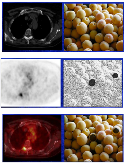 <p>Si on fait un scanner sur un panier d’abricot, je vais voir que j’ai des abricots mais je vais pas voir s’ils sont pourris (me montre pas la dérégulation d’un processus métabolique). On va seulement avoir des infos sur la quantité d’abricots, leur taille, leur localisation. </p><p>Si on fait une scintigraphie sur ce même panier d’abricot, je vais pas avoir bcp d’infos sur leur taille, leur nombre, etc. car la résolution n’est pas bonne mais je vais pouvoir voir qu’il y en a deux qui sont pourris. </p><p>→<strong>Donc faire de l’imagerie hybride = de l’imagerie morphologique associée à de l’imagerie fonctionnelle permet de voir des sites cancéreux ET de les localiser</strong></p><p><span style="color: purple"><strong>Couplage gamma caméra / Scanner X →Intérêt : Meilleure localisation de la lésion, du processus fonctionnel </strong></span></p>