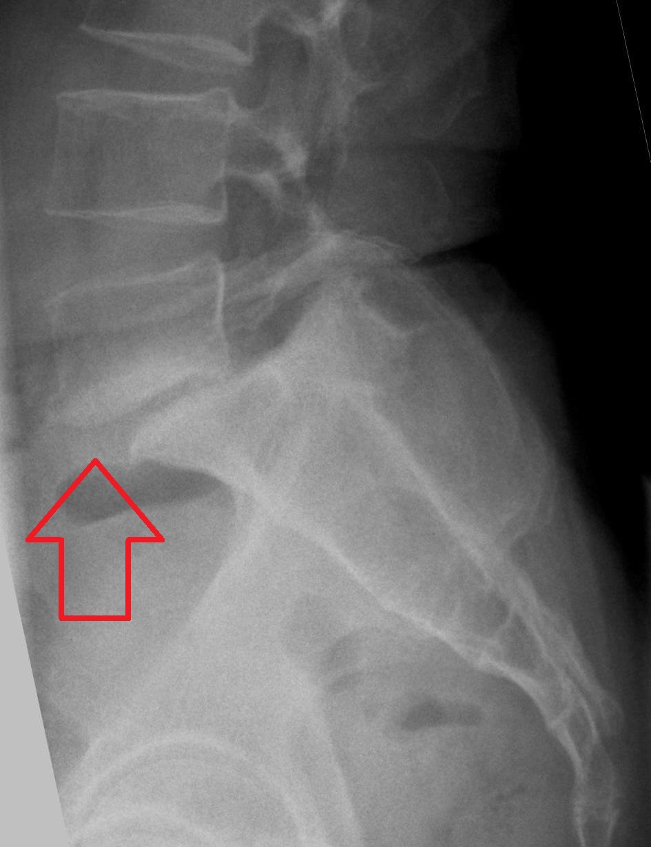 <p>spondylolisthesis</p>