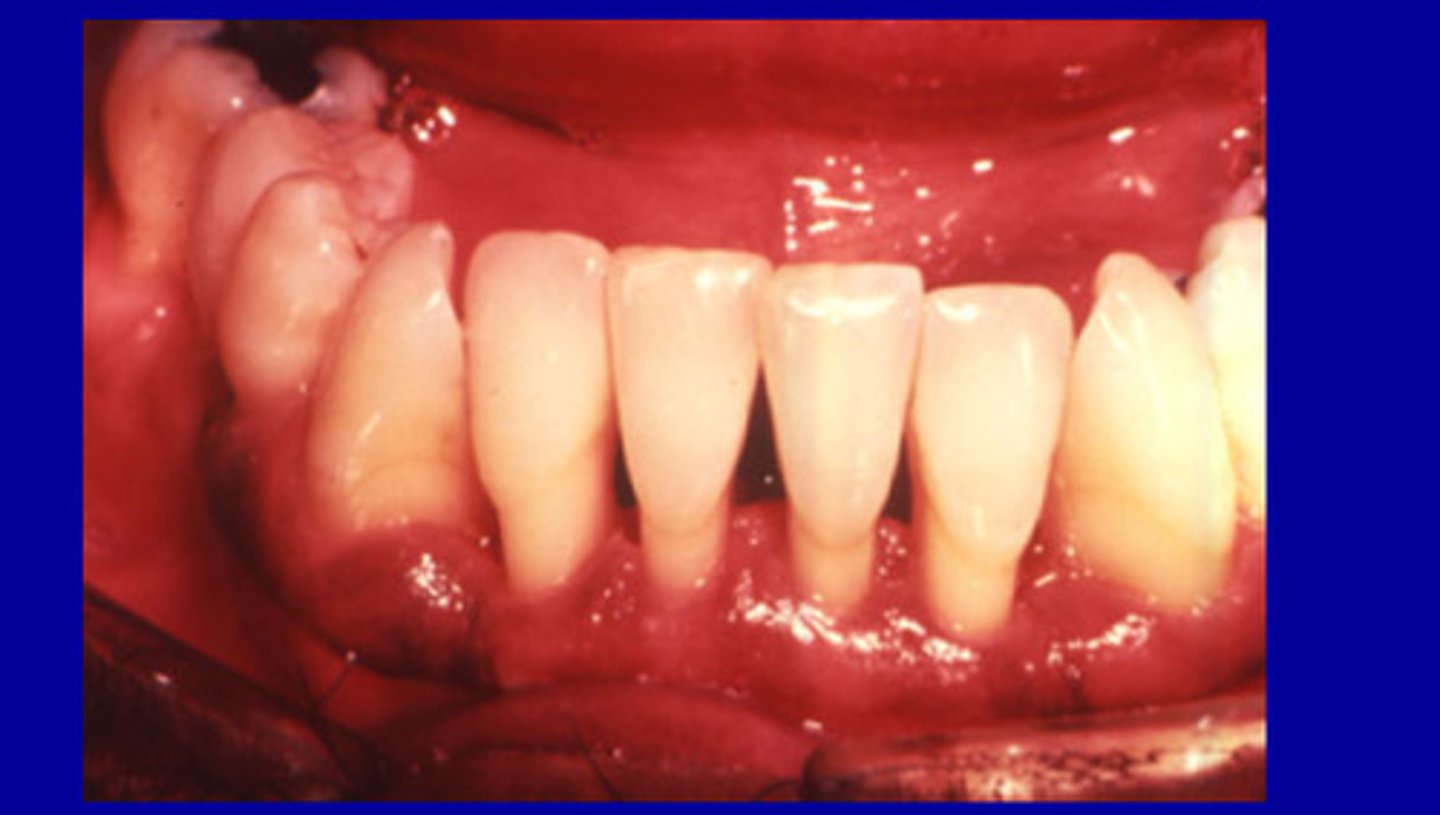 <p>Occur after periodontal surgery, dips down cervically and usually self corrects</p>
