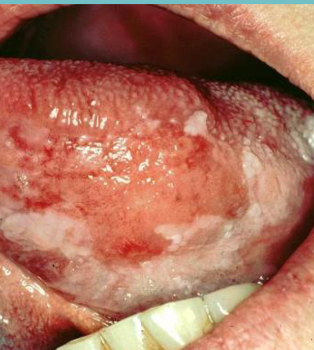 <p>Squamous cell carcinoma </p>