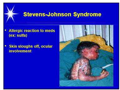 <p>Steven-Johnson Syndrome</p>