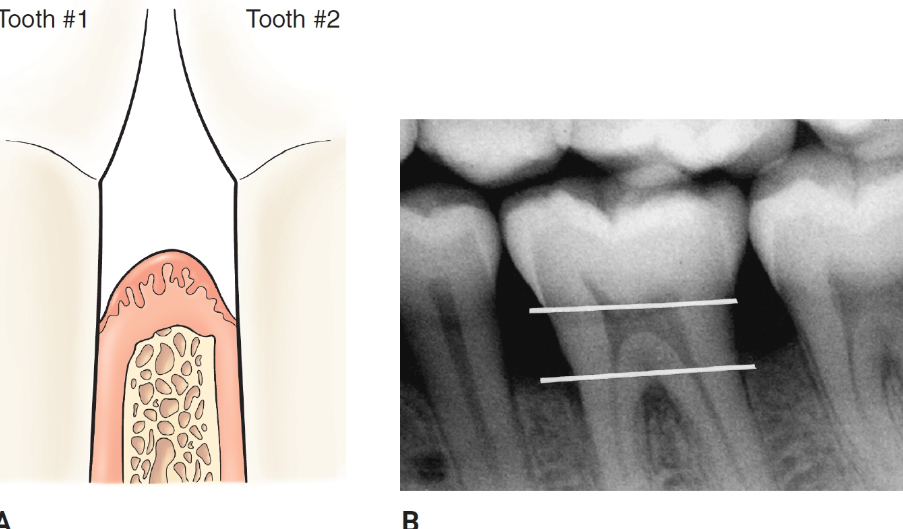 <p>alveolar bone is reduced in height, but the crest margin remains perpendicular to the long axis of the tooth</p>