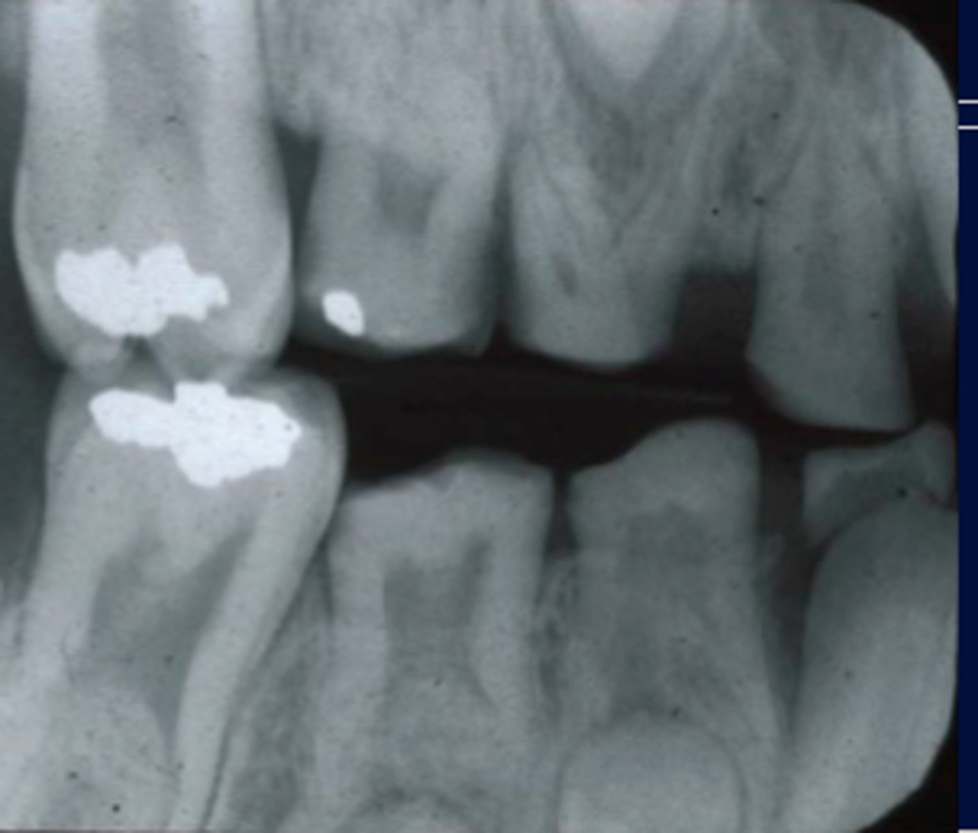 <p>amelognesis imperfecta</p>