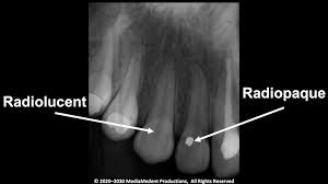 <p>a material’s ability to block or absorb radiation, particularly X-rays, making it appear white or bright on imaging </p>