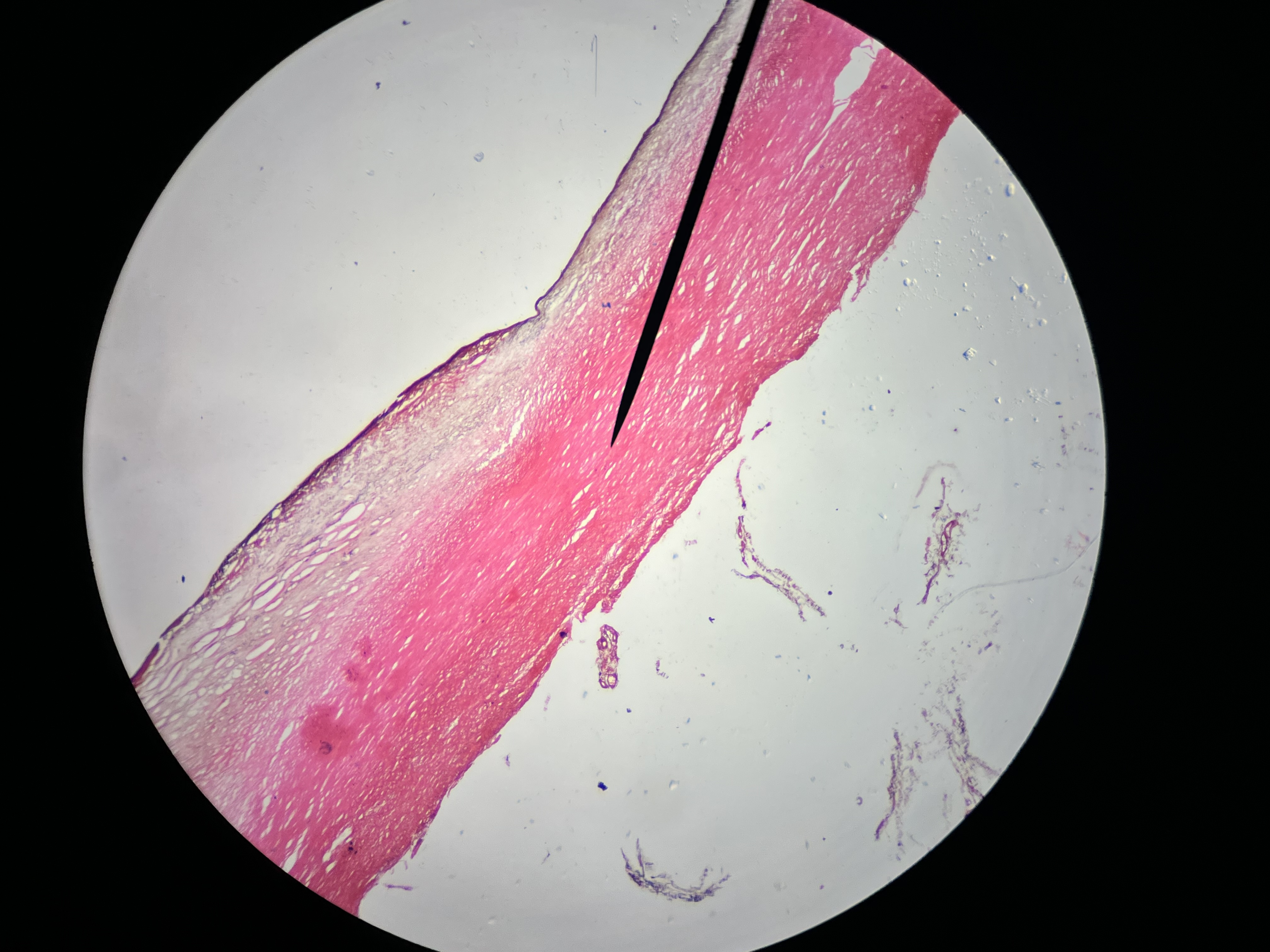 <p>Histomorphologic findings: typically include the presence of atherosclerotic plaques characterized by a fibrous cap and a necrotic core, with accumulation of lipids.</p>