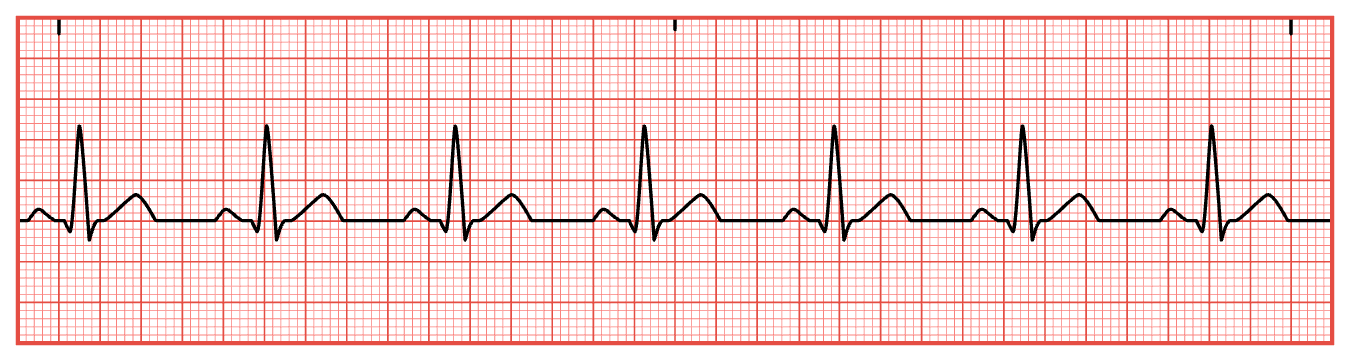 <ol type="1"><li><p><span style="font-family: &quot;Times New Roman&quot;;">Calculate heart rate.</span></p></li><li><p><span style="font-family: &quot;Times New Roman&quot;;">Determine if heart rhythm is regular.</span></p></li><li><p><span style="font-family: &quot;Times New Roman&quot;;">Assess for P waves.</span></p></li><li><p><span style="font-family: &quot;Times New Roman&quot;;">Measure PR interval.</span></p></li><li><p><span style="font-family: &quot;Times New Roman&quot;;">Measure duration of QRS complex.</span></p></li></ol><p></p>