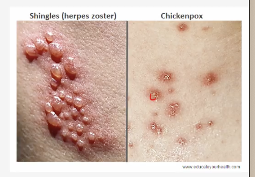 <ul><li><p><strong>Pruritic (itchy), papular rash</strong> that changes to <strong>vesicular</strong> → “<strong>dewdrops on a rose petal</strong>” <span data-name="rose" data-type="emoji">🌹</span></p></li><li><p>Lesions <strong>evolve into pustules</strong>, then <strong>crust over</strong>.</p></li></ul><p></p>